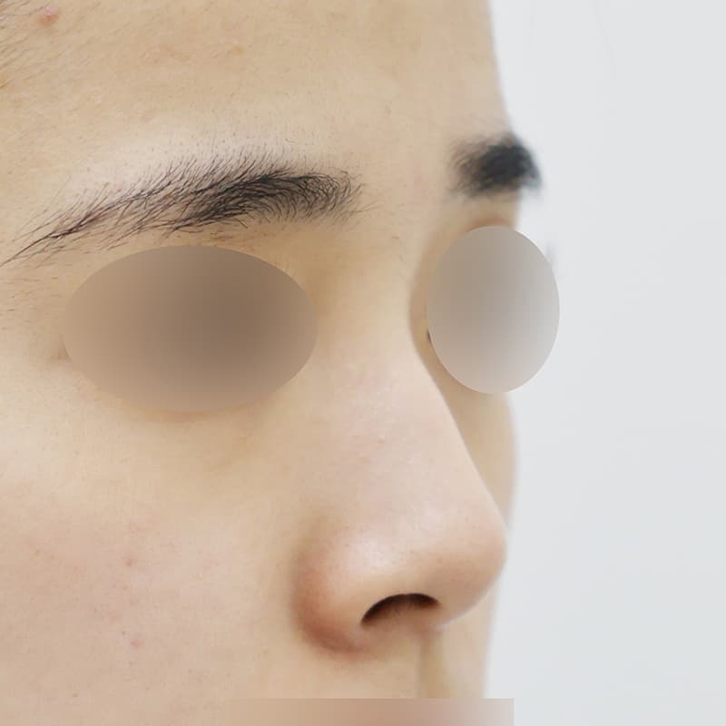 코성형 수술 전