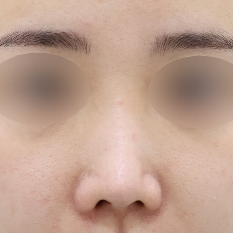 코재수술2 수술 전
