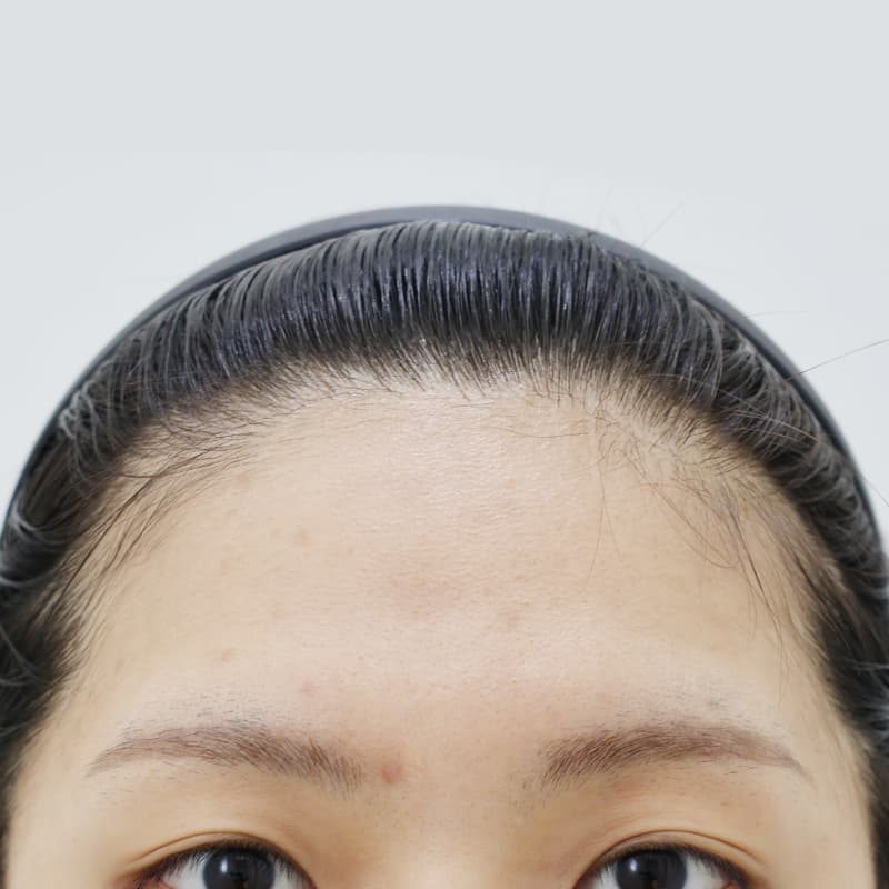내시경 이마거상 수술 전