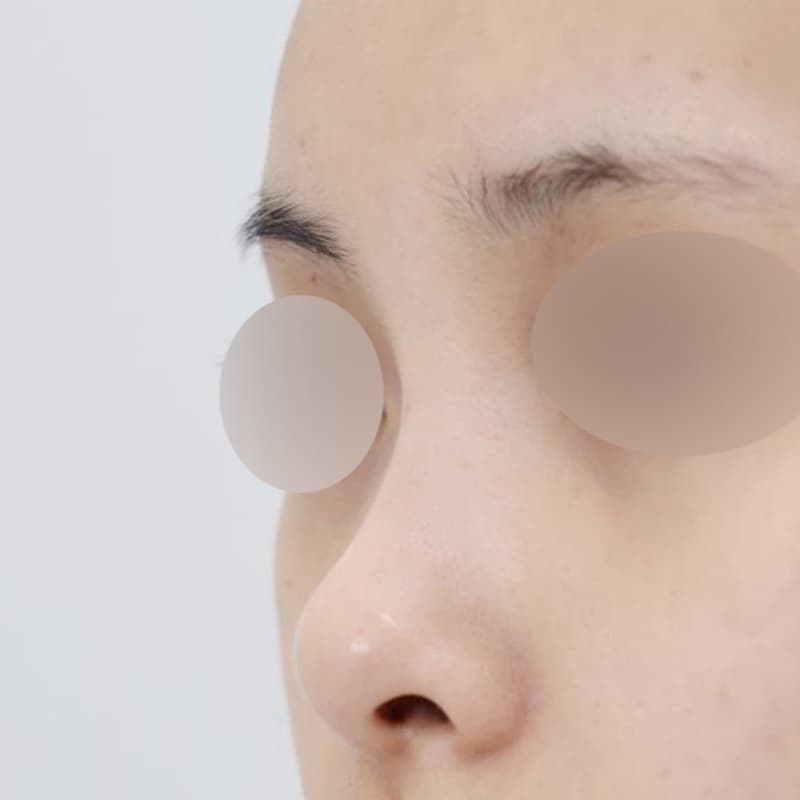 코성형 수술 전