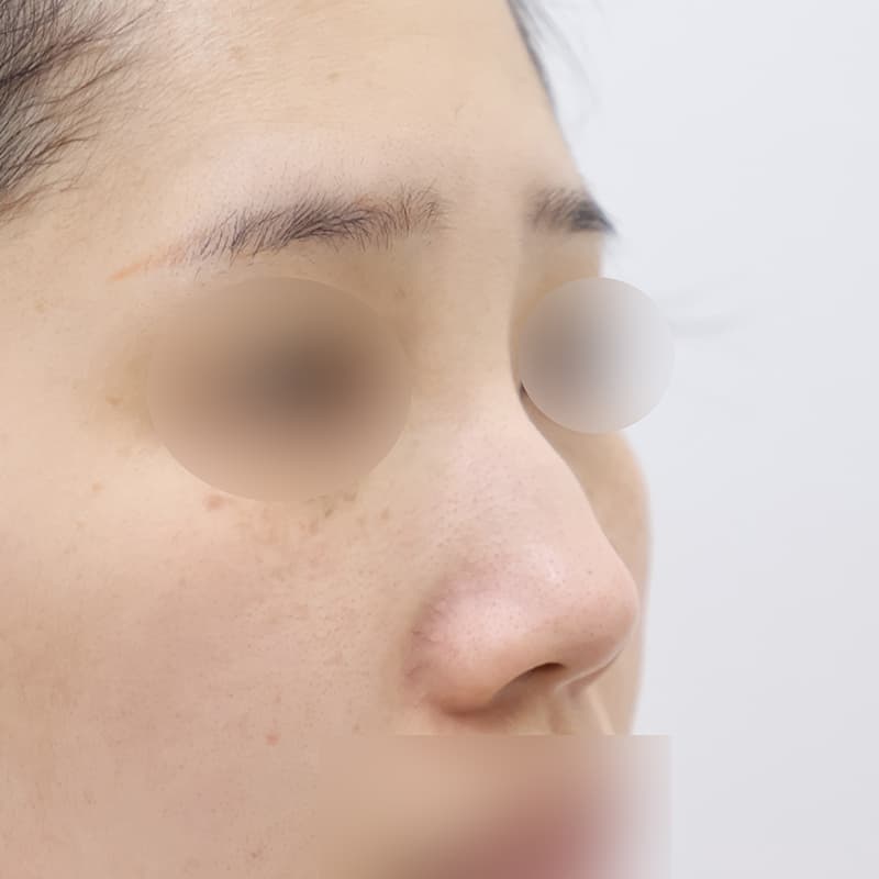 코재수술 before