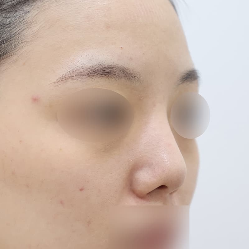 코재수술 before