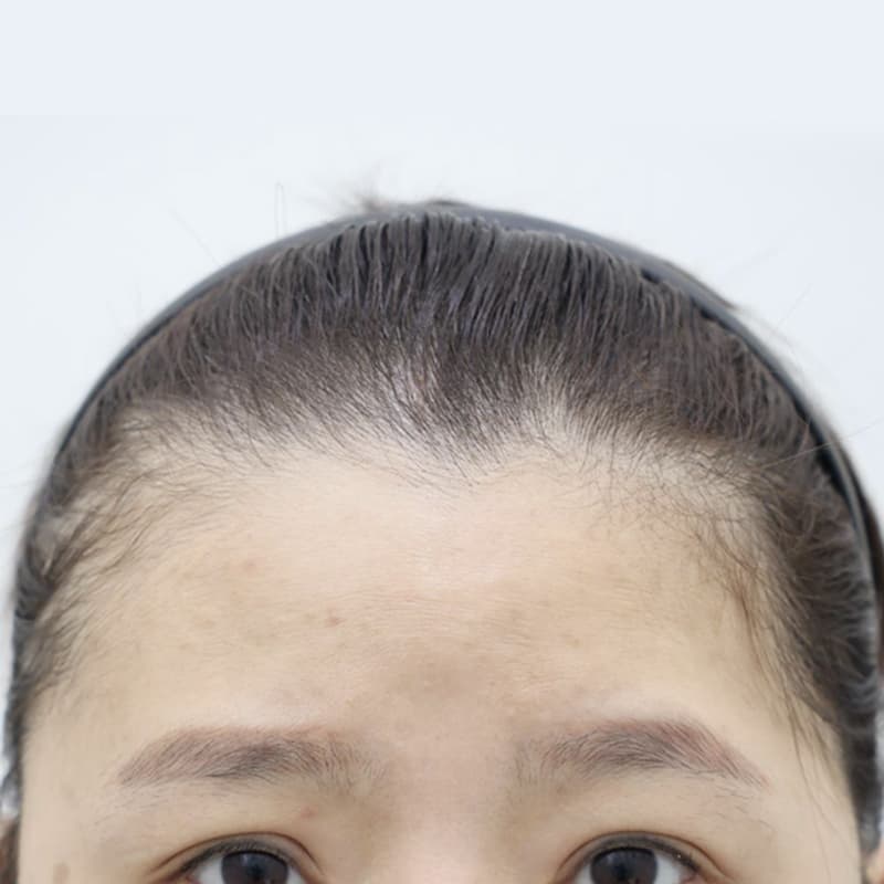 내시경 이마거상 before