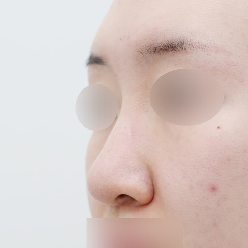 코재수술 before