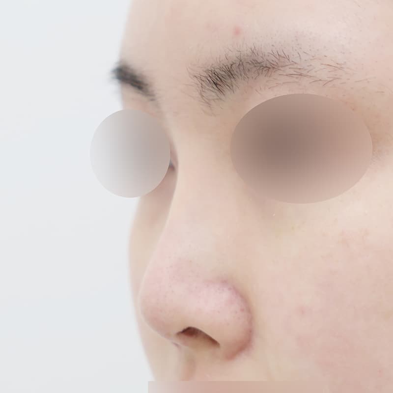 코재수술 before