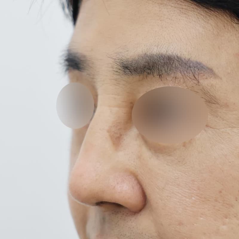 코재수술 before