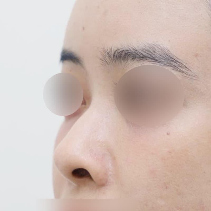 코재수술 before