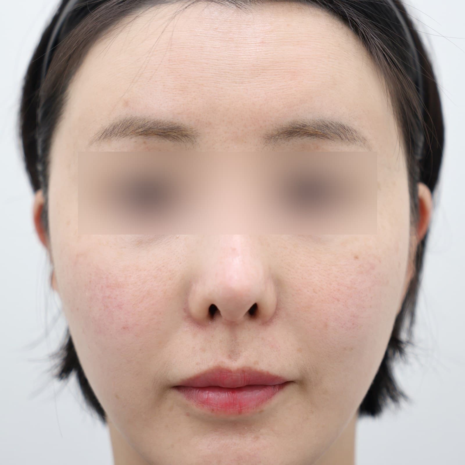 귀필러 8cc before
