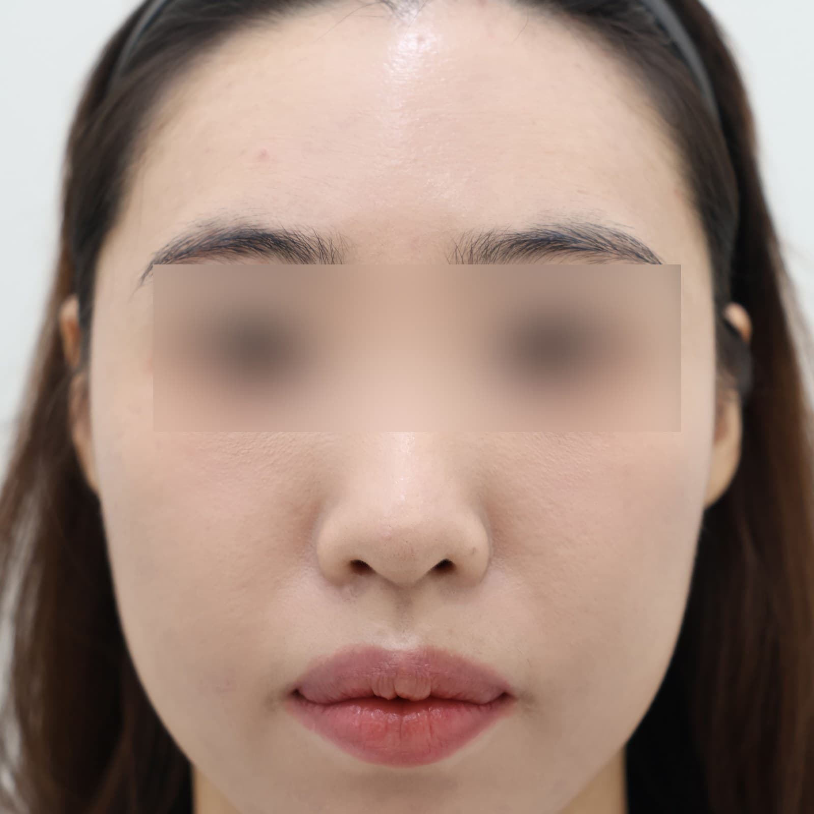 귀필러 8cc before