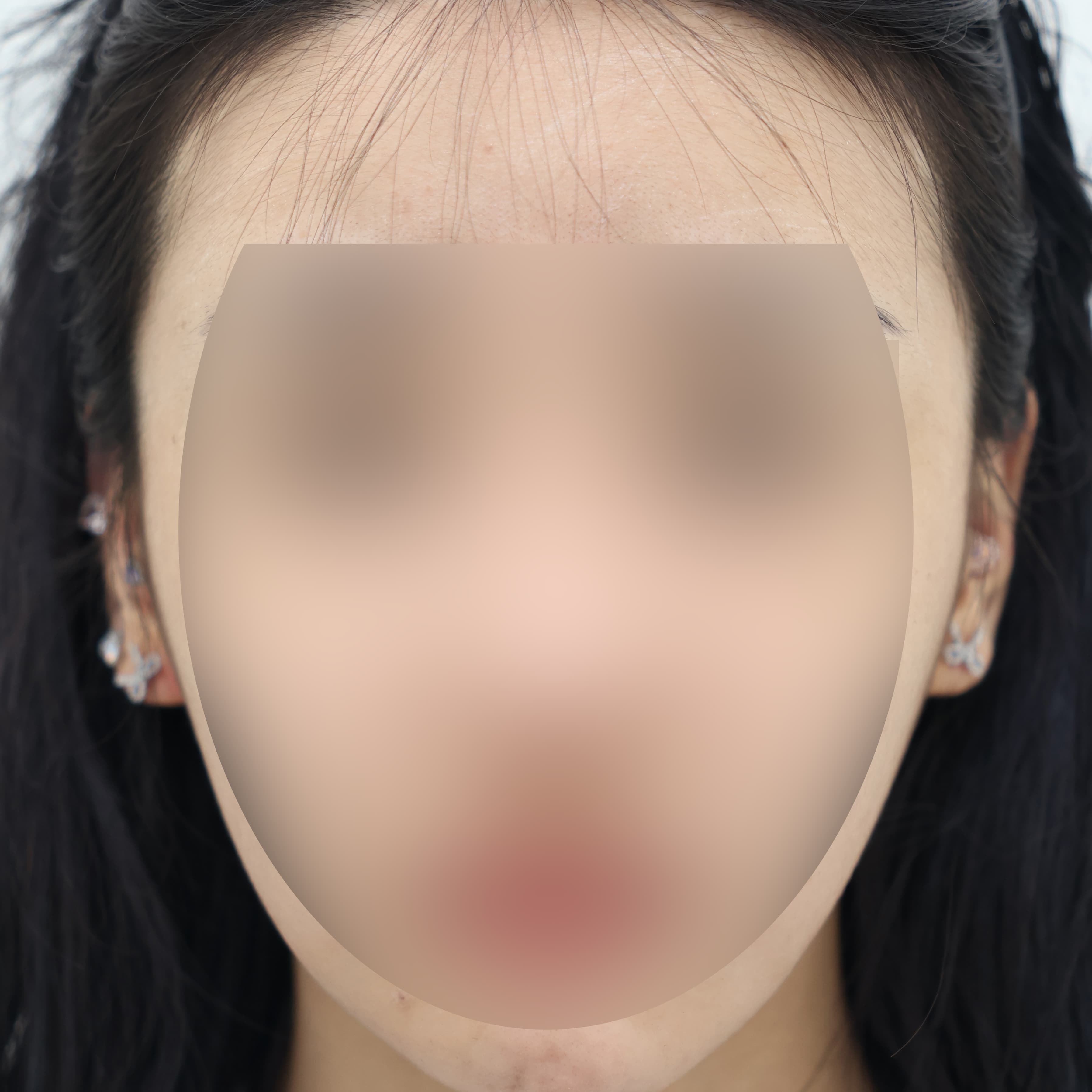 귀필러 7cc before