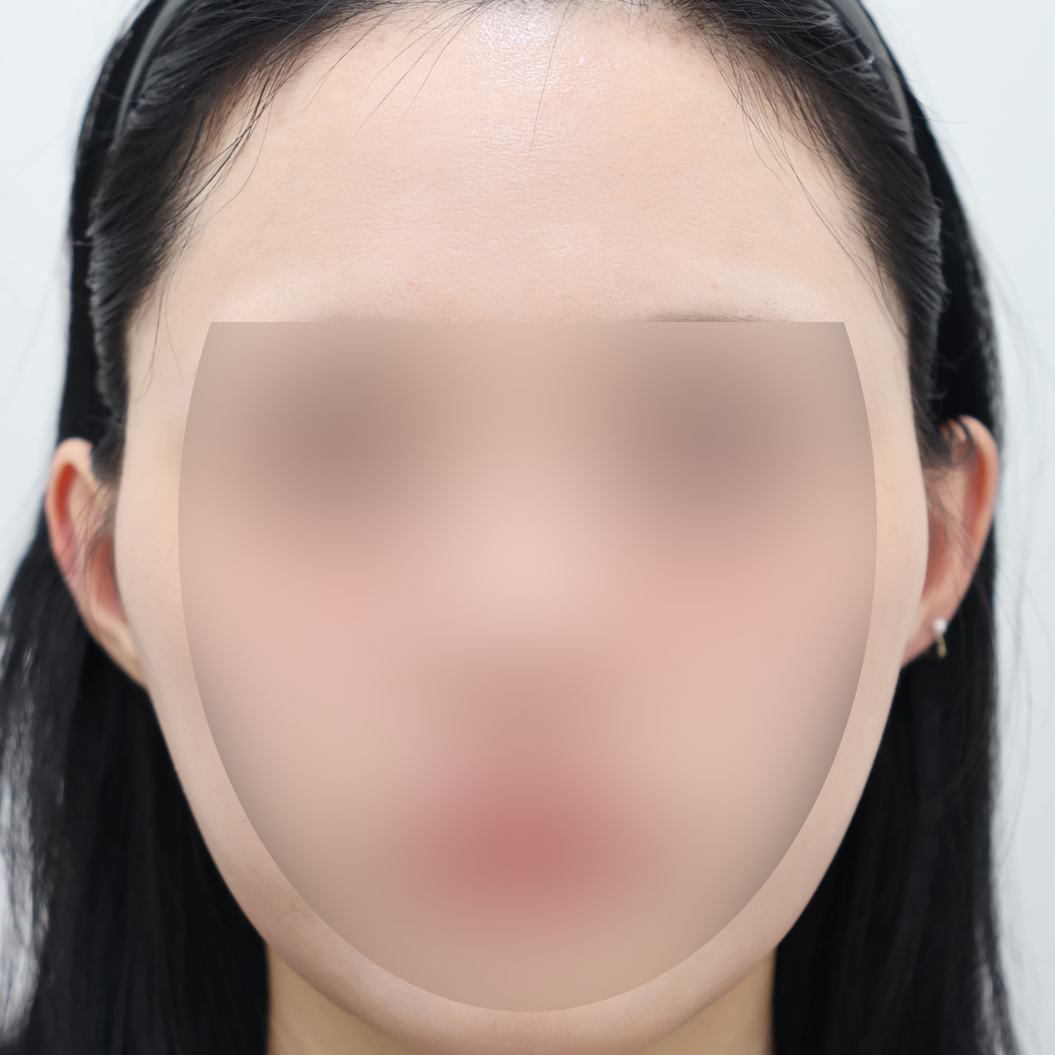 귀필러 6cc before